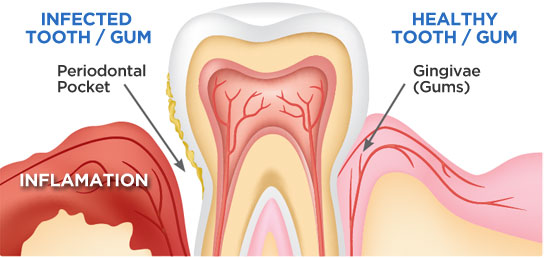 Bệnh viêm nha chu phòng ngừa như thế nào?