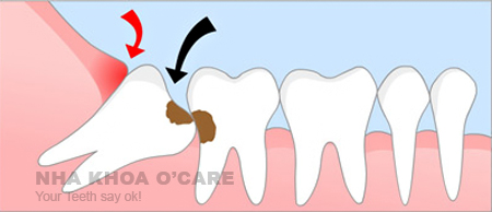 răng khôn số 8 mọc lệch