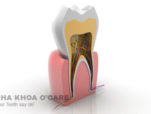 Điểu trị viêm tủy răng