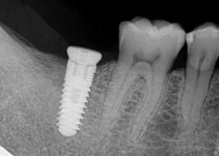 Phục hình răng sứ trên Implant