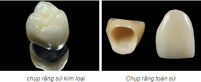 bọc răng sứ02