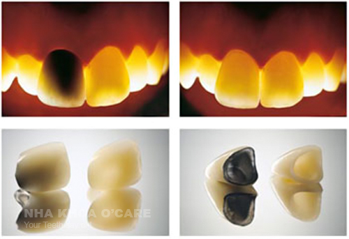 bọc răng sứ zirconia