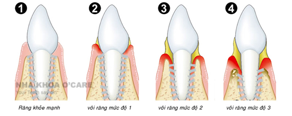 Cạo vôi răng an toàn vô trùng