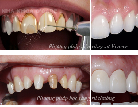 bọc răng sứ veneers