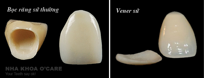 bọc răng sứ veneers