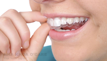 niềng răng trong suốt invisalign