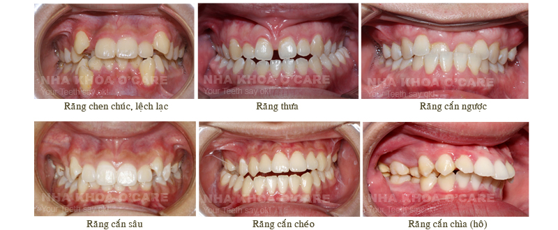 Chỉnh nha Invisalign, không mắc cài