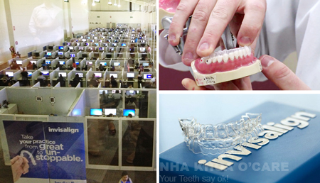 Chỉnh nha Invisalign, không mắc cài