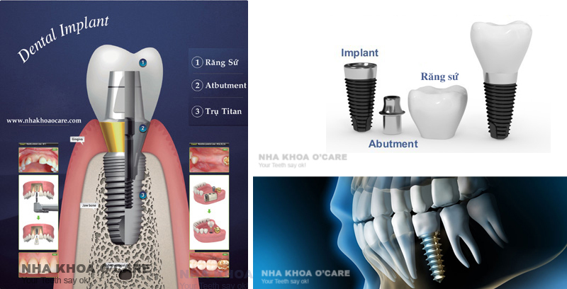 trồng răng giả implant