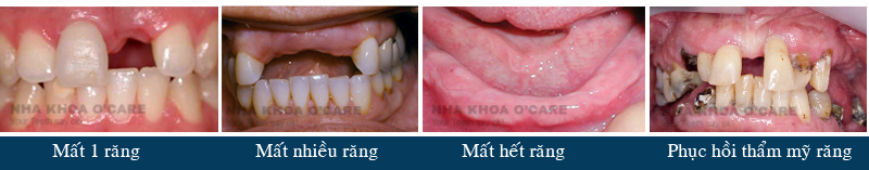 trồng răng giả implant