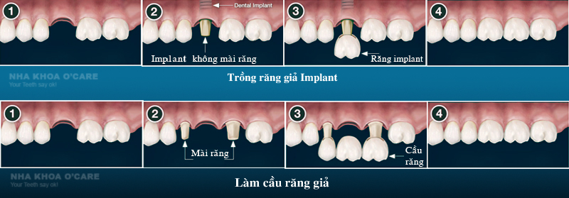 Cấy ghép implant uy tín tại TPHCM