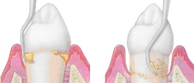 điều trị viêm nha chu