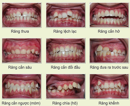 Niềng răng, giải pháp điều chỉnh lại hàm răng lệch lạc, hô móm